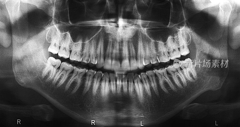 牙科x光