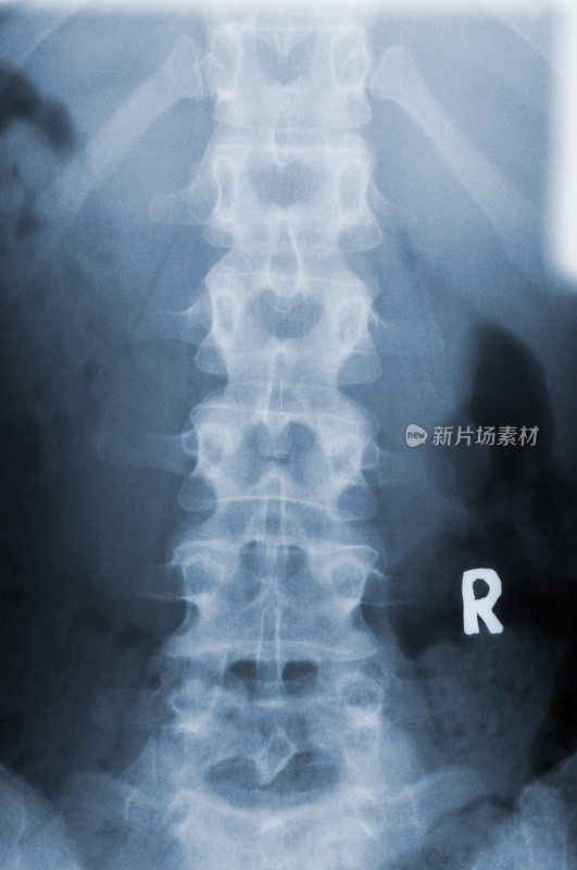 人脊柱x线片显示右侧R