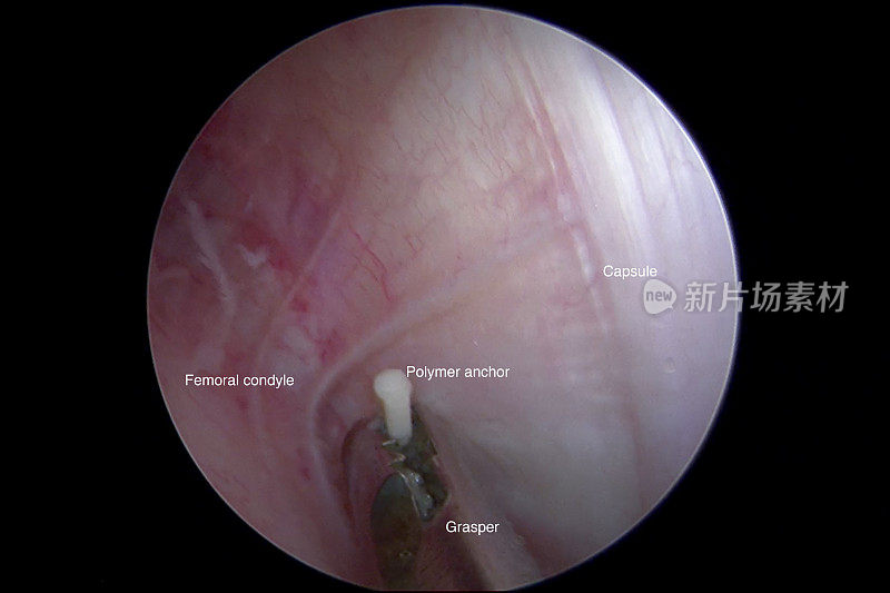 关节镜摘除膝关节异物