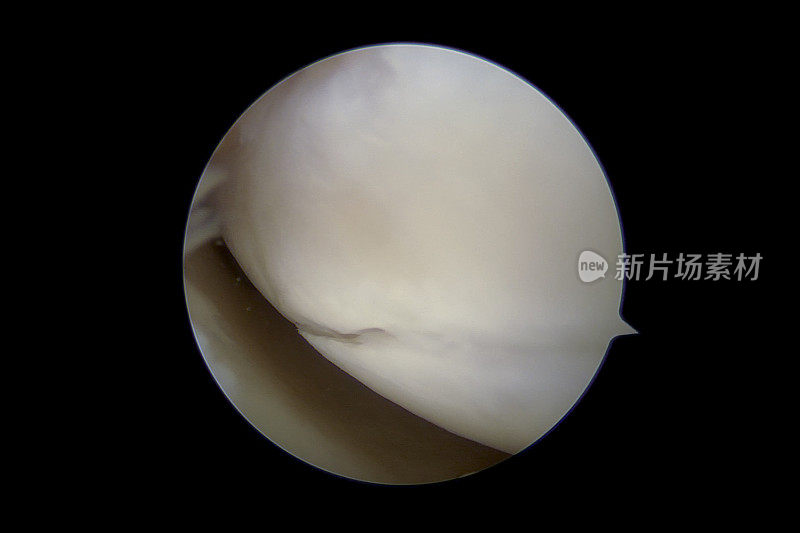 右膝内侧腔室关节软骨撕裂的关节镜照片