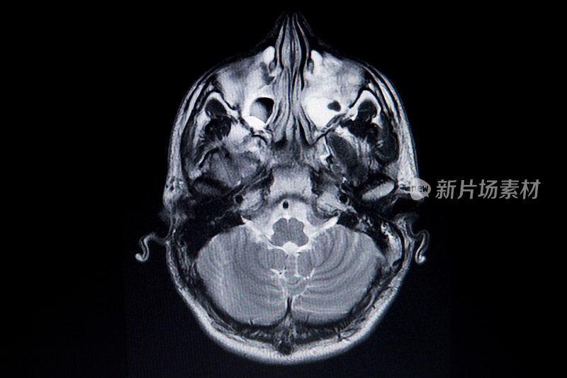 核磁共振大脑扫描