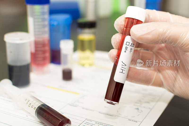 HIV——试管中的血液