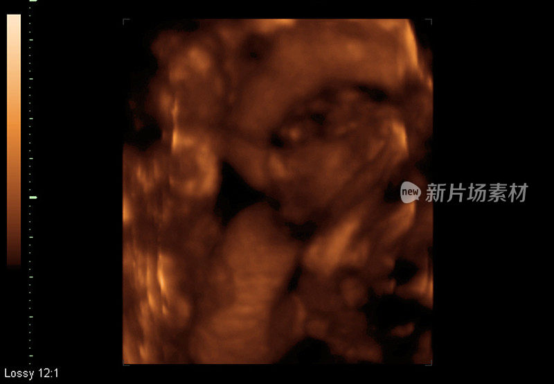 胎儿宝宝超声波屏幕截图