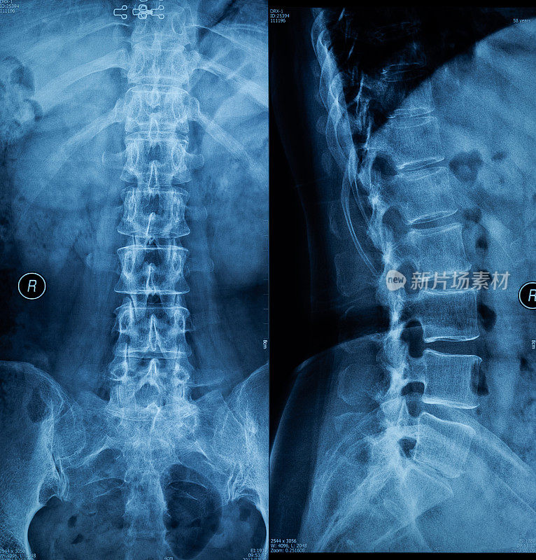 脊柱x射线胶片