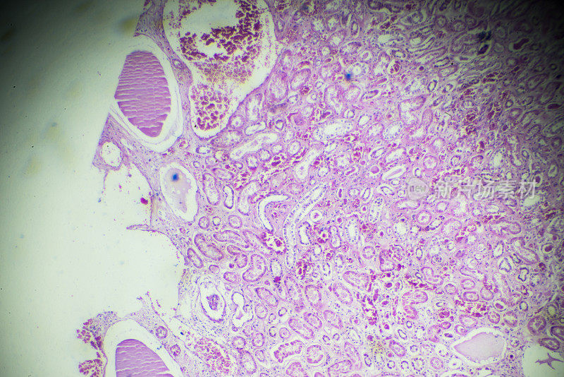 显微镜下急性肾炎活检标本