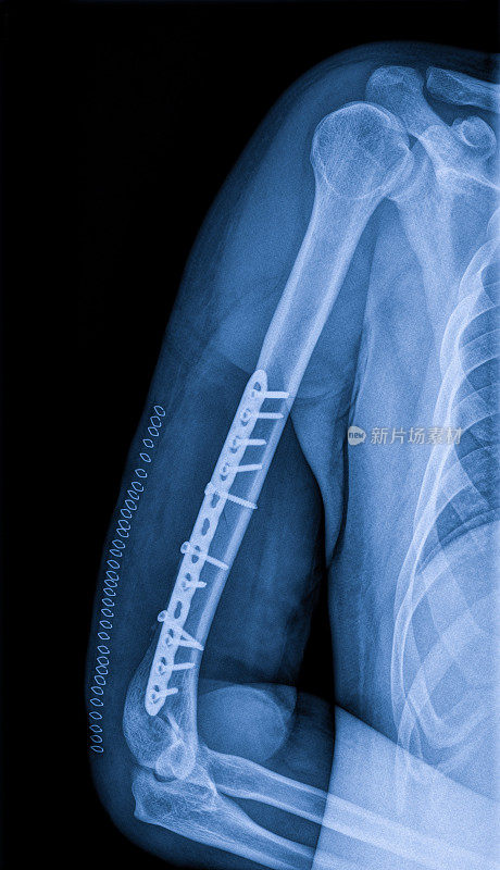 手臂骨折x光片