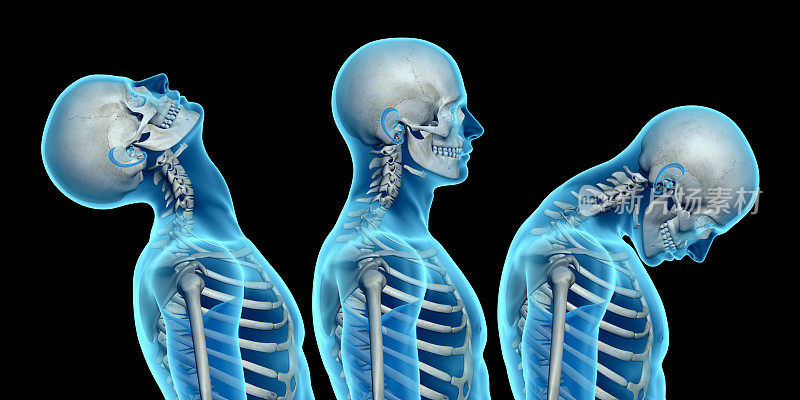 人体解剖，显示颈部损伤，如颈部鞭伤
