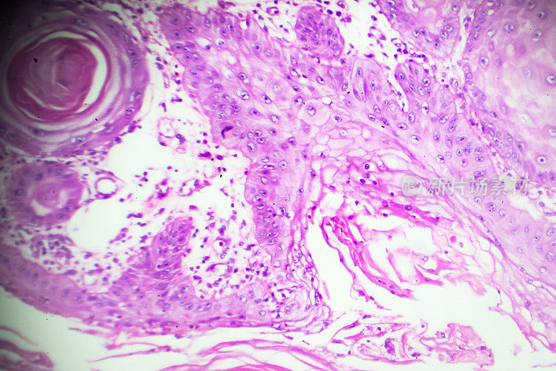 鳞状细胞癌显微镜下