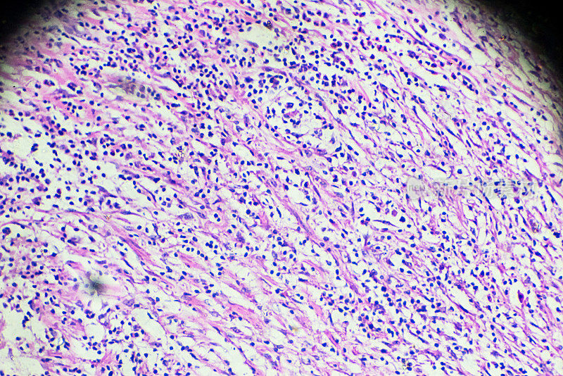 何杰金氏细胞病，淋巴瘤，显微镜下的HL