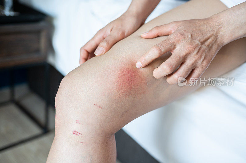 近距离的妇女有痒引起的红色皮疹在她的大腿。