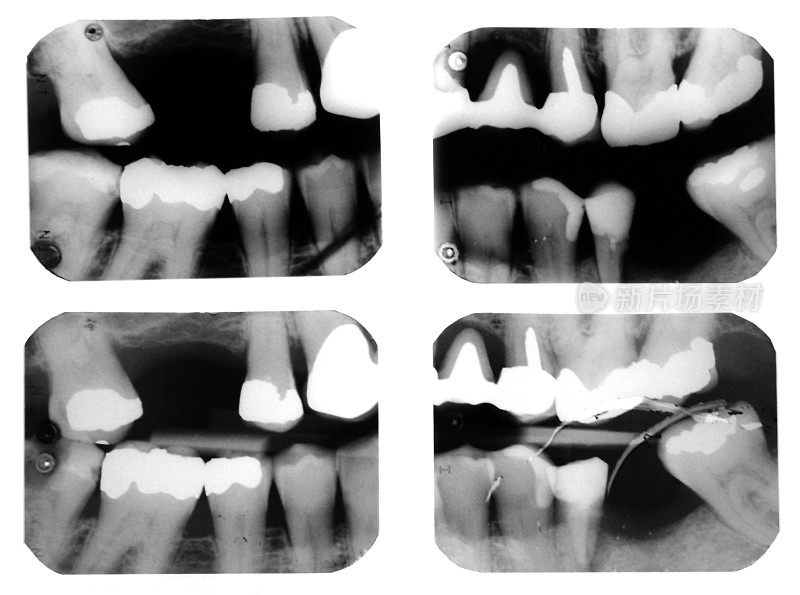 四张牙齿x光照片
