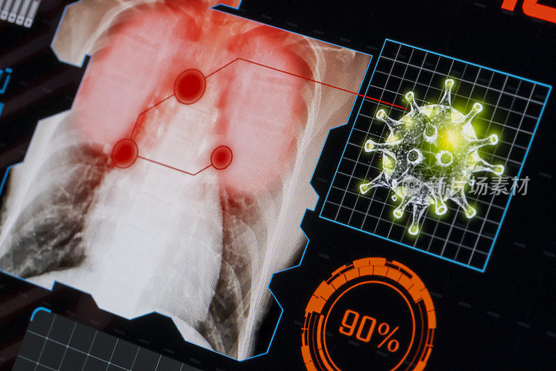 冠状病毒信息数据，肺部x线显示在屏幕上。