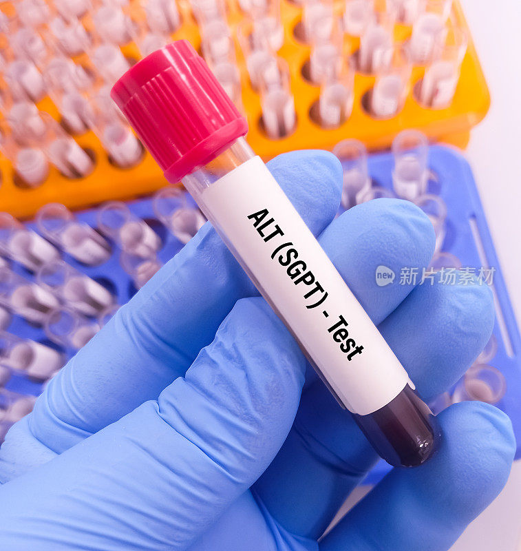 抽血做谷丙转氨酶(ALT)或SGPT测试，肝功能测试。ALT血检。