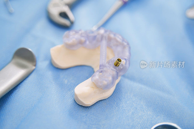 口腔临床种植牙模型的建立