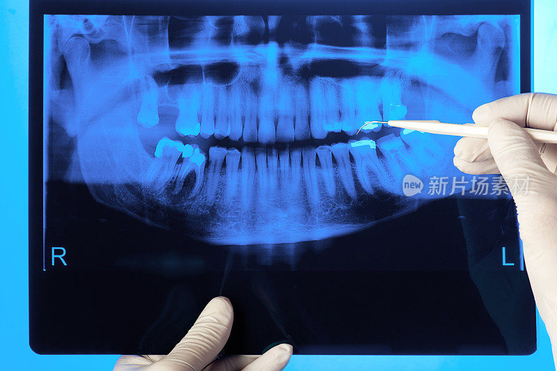 牙医检查x射线