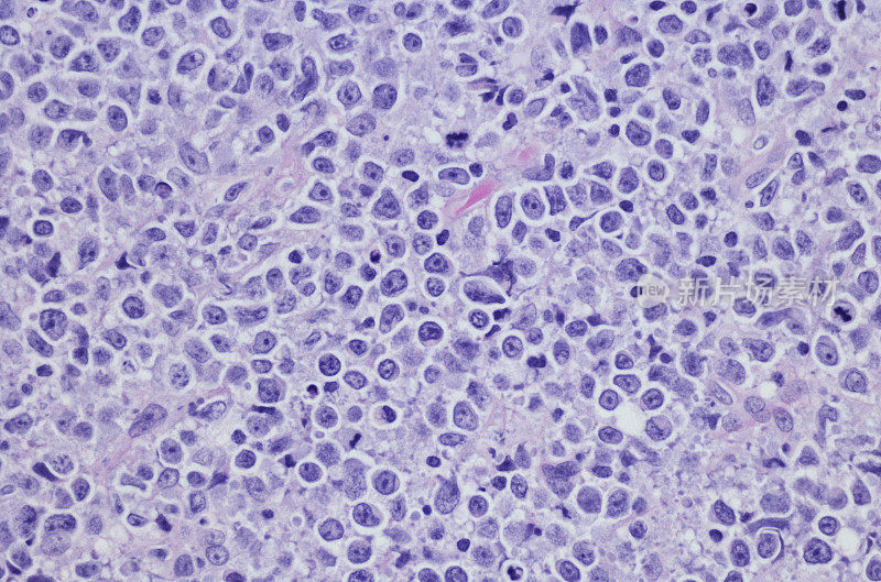 原发性皮肤大b细胞淋巴瘤，腿型