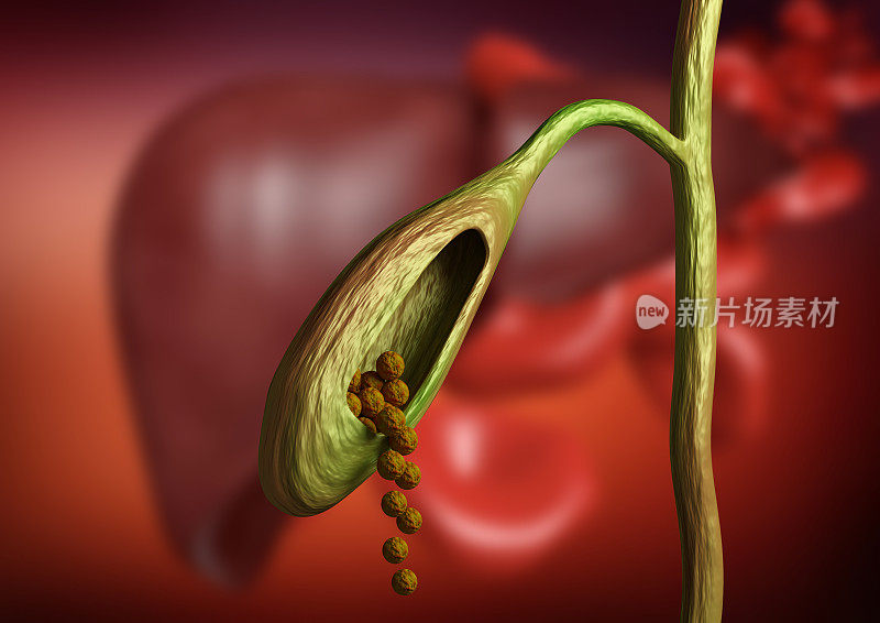 在器质性背景下，胆囊切开术显示胆囊结石阻塞胆管。三维渲染