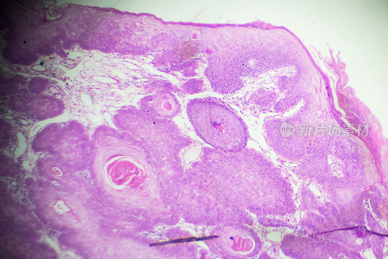 鳞状细胞癌显微镜下