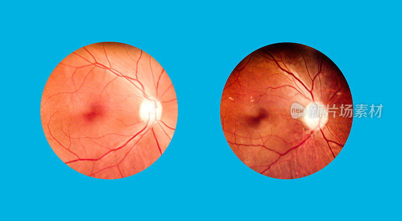 老年糖尿病视网膜患者。用瞳孔视网膜相机拍摄人眼解剖图像。