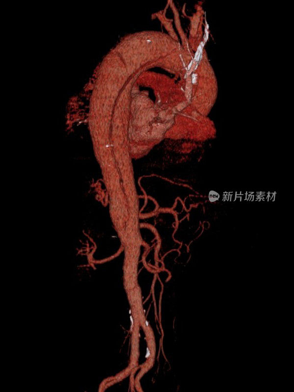 心脏和主动脉的三维计算机断层扫描