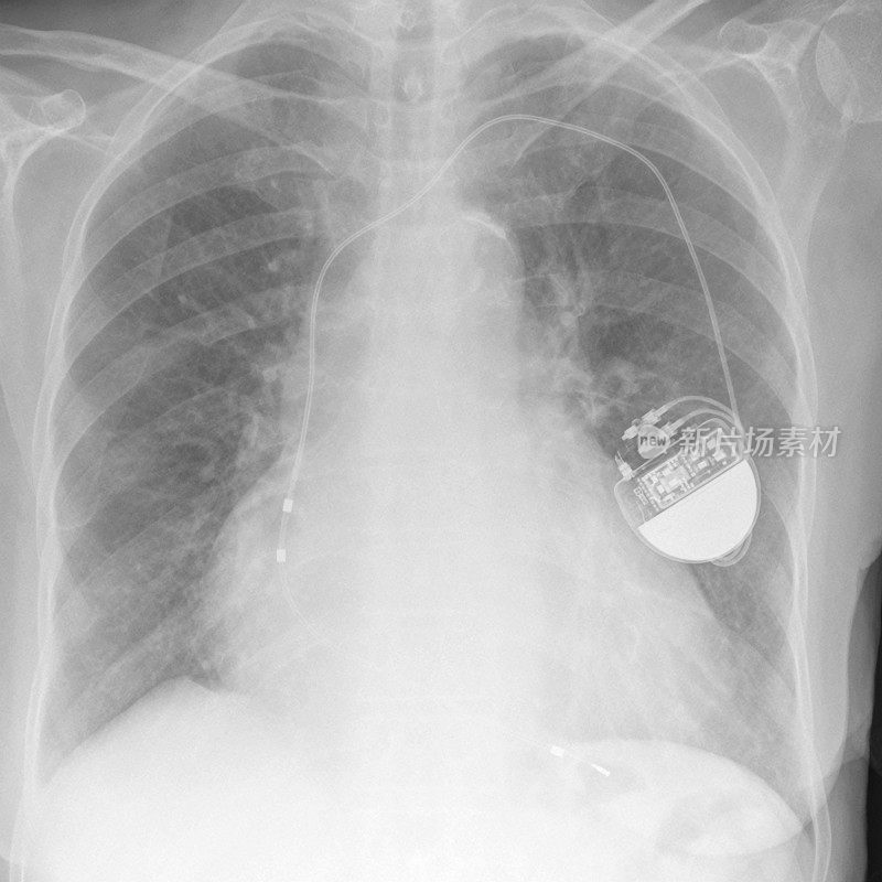 起搏器和大心脏的数字胸部x光片