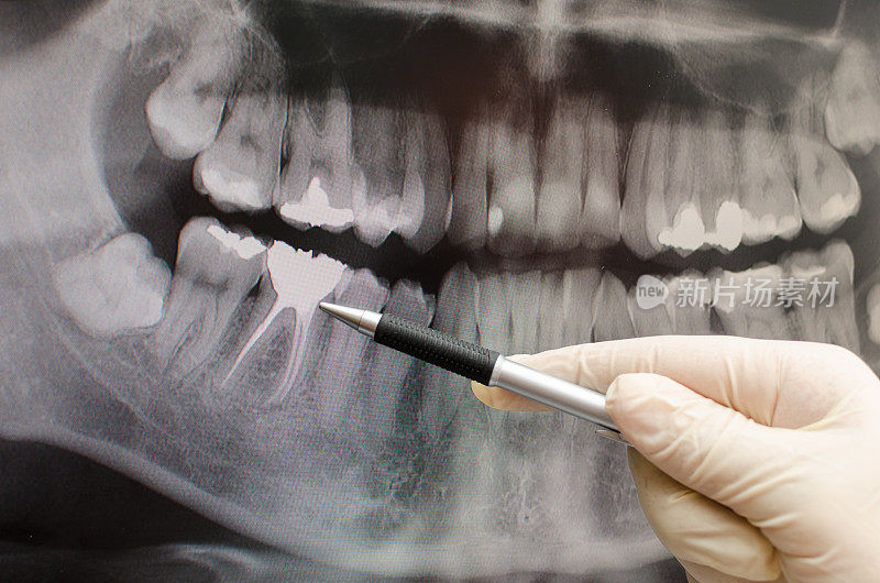 牙科医生在牙科x光图像上显示了一些东西