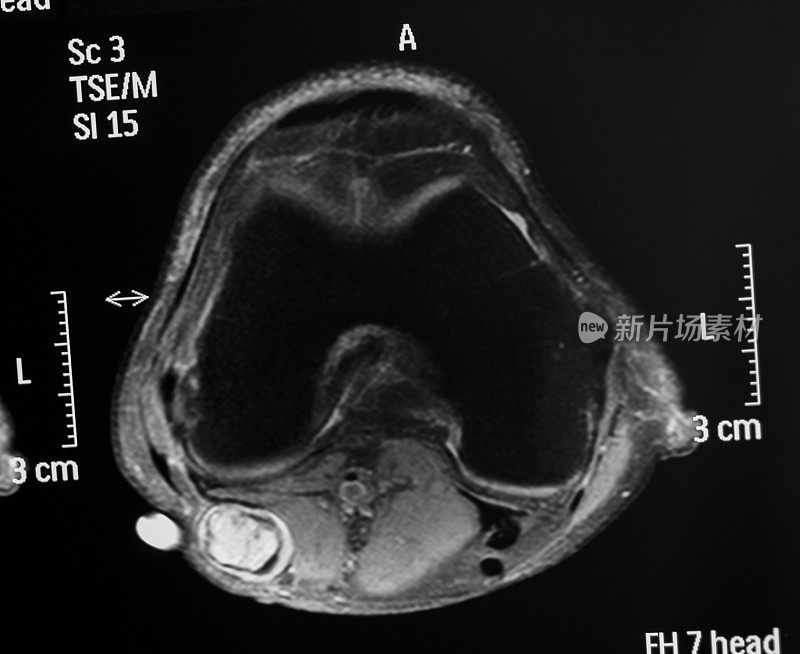 膝关节MRI轴位示神经肿瘤