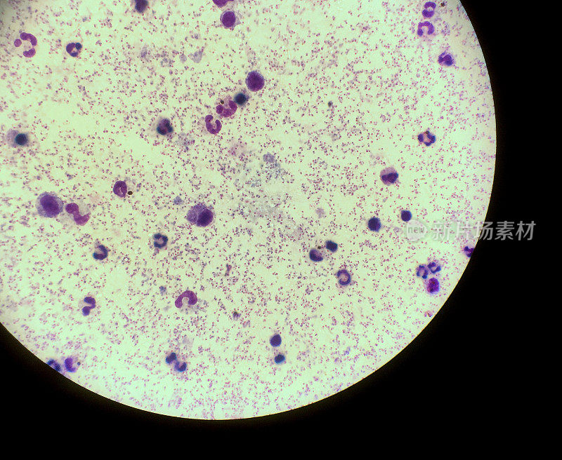 疟疾、Plasmodiun恶性