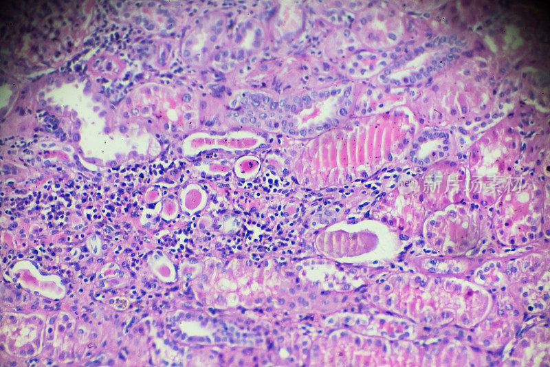 光镜下慢性肾盂肾炎活检
