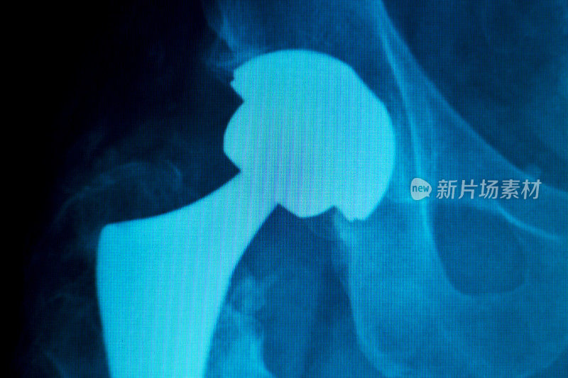骨科膝关节钛合金现代金属植入物螺钉置换术的老年患者x线扫描。