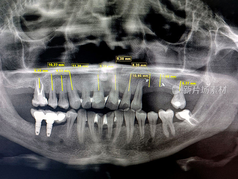 牙齿结构受损并失去一颗牙齿的人，在植牙前要照x光