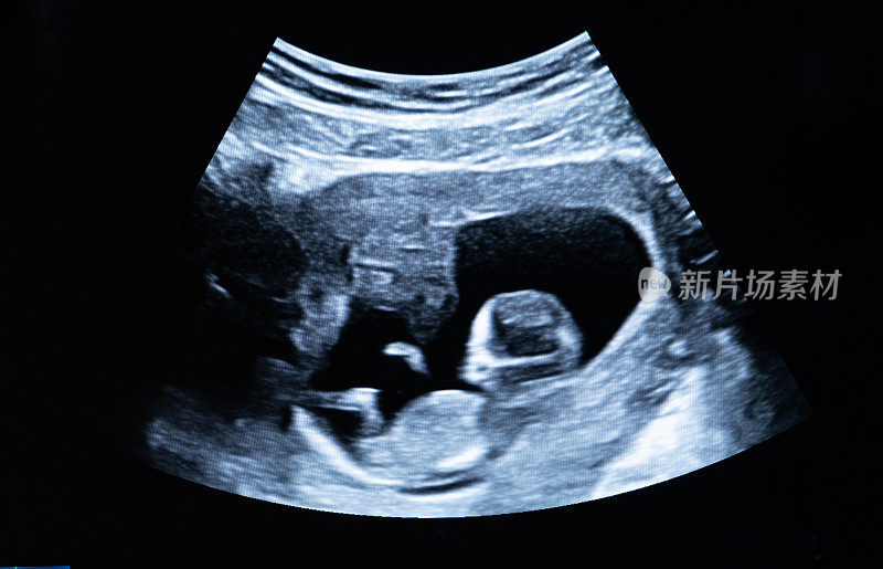 胎儿或婴儿在怀孕期间的超声图像