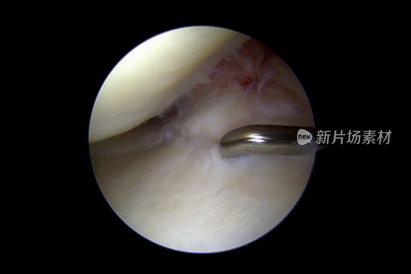 后半月板根骨撕脱性骨折