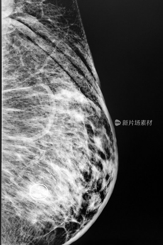 乳房x光射线