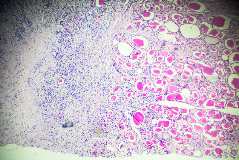 显微镜下的单纯甲状腺肿
