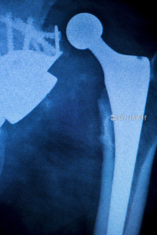 骨科膝关节钛合金现代金属植入物螺钉置换术的老年患者x线扫描。