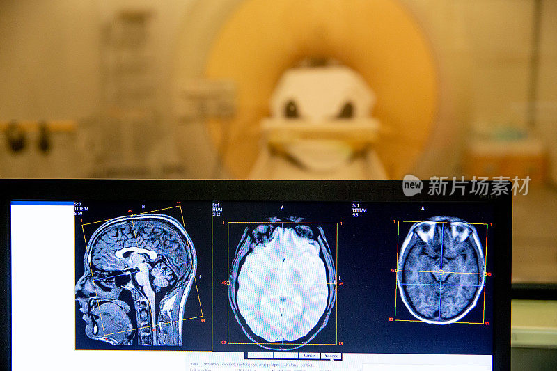 磁共振头部扫描图像在电脑显示器扫描