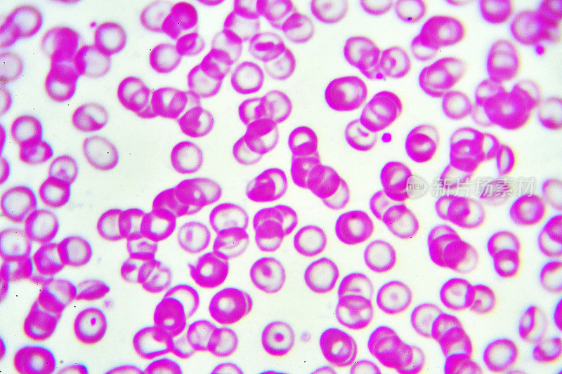 红细胞异常