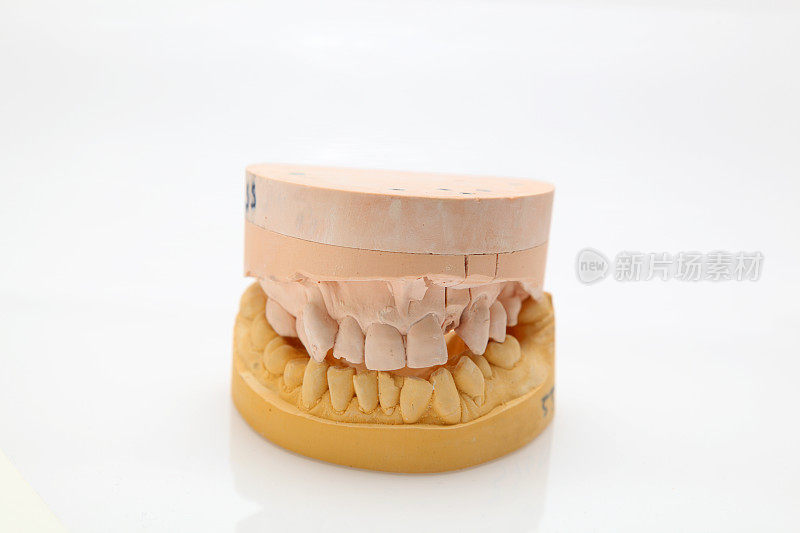 牙科石膏模型的牙冠或种植
