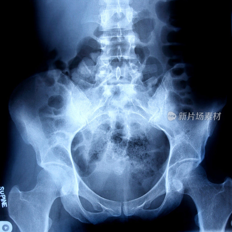 人体臀部x射线图像