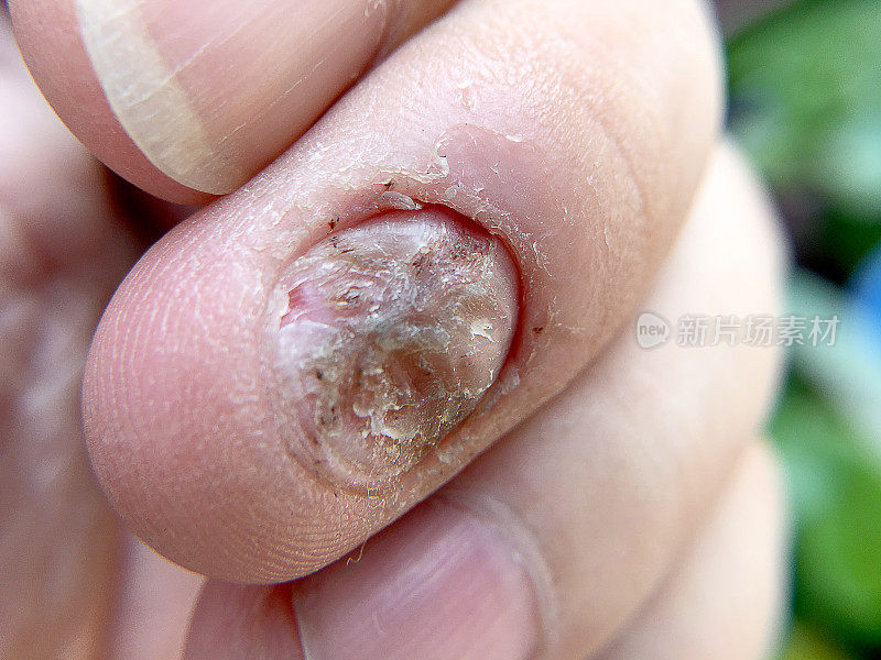 指甲真菌感染和手部损伤。