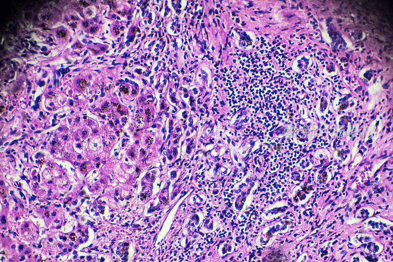 胆汁性肝硬化。显微镜下的人类病理标本