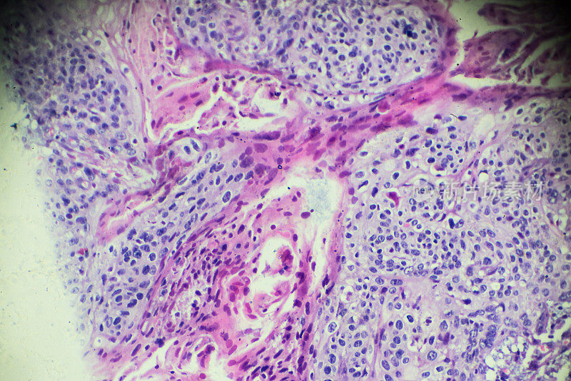 光镜下的子宫颈癌(鳞状细胞癌)