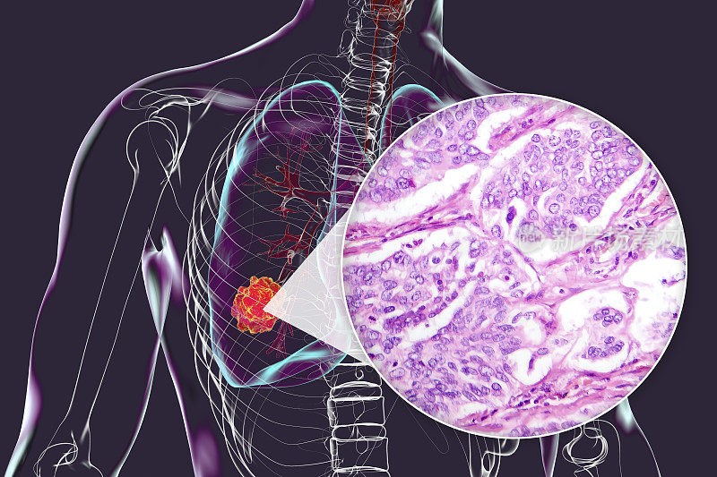 肺癌，三维插图和光学显微照片