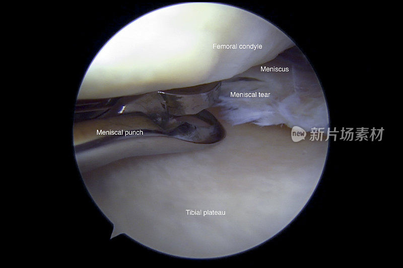 左膝内侧半月板后部复杂退行性撕裂的关节镜观察