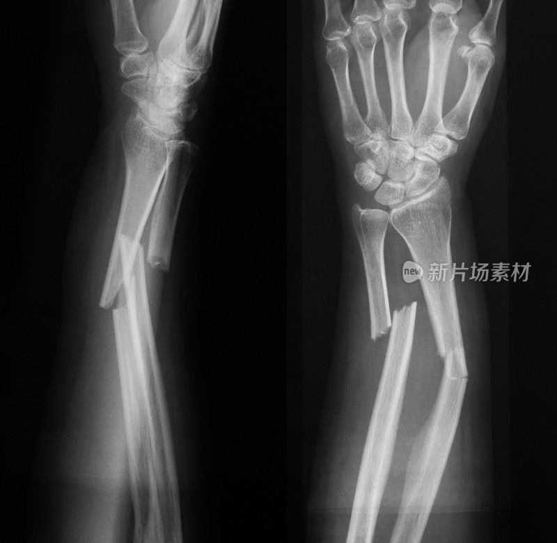 前臂骨折x线照片，正位片和侧位片
