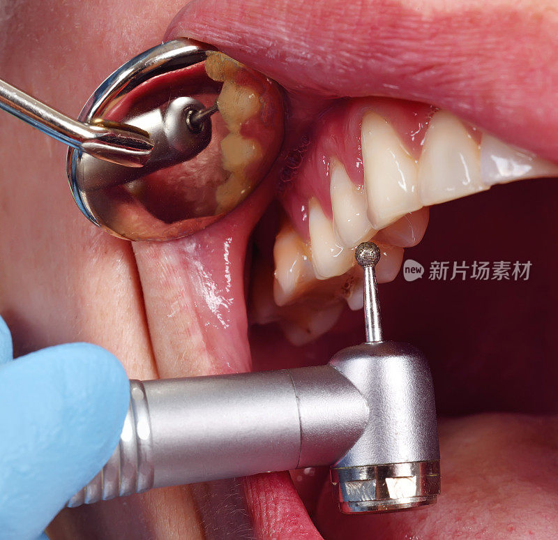 牙医使用牙钻