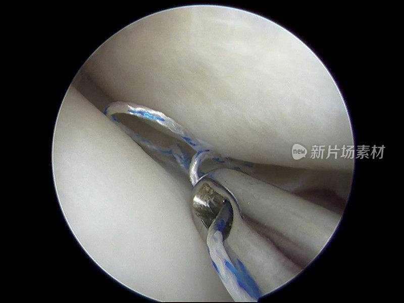膝关节全内半月板修复的关节镜观察