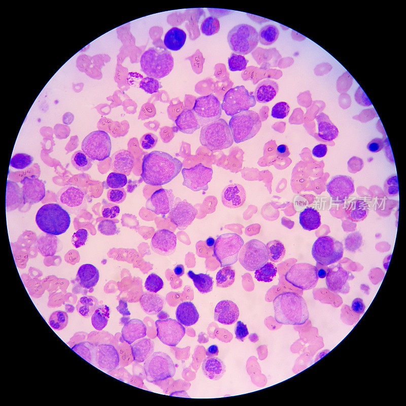 白血病患者血液涂片的显微镜观察