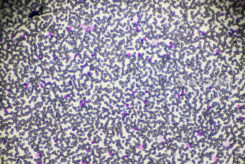 光镜下急性淋巴母细胞白血病ALL-L3血液涂片